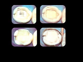 Endodontia Em Dentes Deciduos