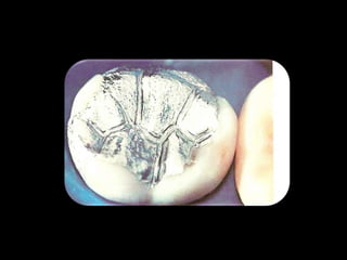 Endodontia Em Dentes Deciduos