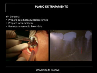 Universidade Positivo
PLANO DE TRATAMENTO
6a. Consulta:
• Preparo para Coroa Metalocerâmica
• Preparo Intra-radicular
• Reembasamento do Provisório
 