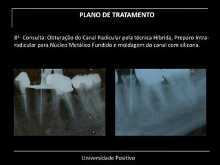 Universidade Positivo
PLANO DE TRATAMENTO
8a. Consulta: Obturação do Canal Radicular pela técnica Híbrida, Preparo Intra-
radicular para Núcleo Metálico Fundido e moldagem do canal com silicona.
 