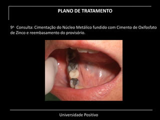 Universidade Positivo
PLANO DE TRATAMENTO
9a. Consulta: Cimentação do Núcleo Metálico fundido com Cimento de Oxifosfato
de Zinco e reembasamento do provisório.
 