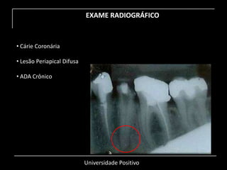 Universidade Positivo
EXAME RADIOGRÁFICO
• Cárie Coronária
• Lesão Periapical Difusa
• ADA Crônico
 