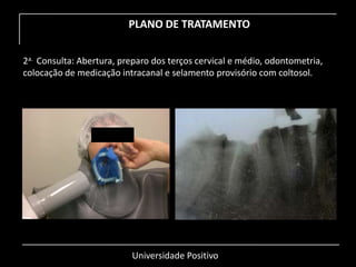Universidade Positivo
PLANO DE TRATAMENTO
2a. Consulta: Abertura, preparo dos terços cervical e médio, odontometria,
colocação de medicação intracanal e selamento provisório com coltosol.
 
