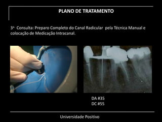 Universidade Positivo
PLANO DE TRATAMENTO
3a. Consulta: Preparo Completo do Canal Radicular pela Técnica Manual e
colocação de Medicação Intracanal.
DA #35
DC #55
 
