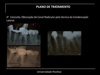 Universidade Positivo
PLANO DE TRATAMENTO
4a. Consulta: Obturação do Canal Radicular pela técnica da Condensação
Lateral.
 