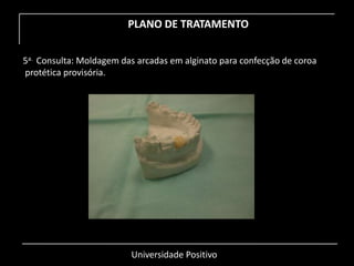 Universidade Positivo
PLANO DE TRATAMENTO
5a. Consulta: Moldagem das arcadas em alginato para confecção de coroa
protética provisória.
 