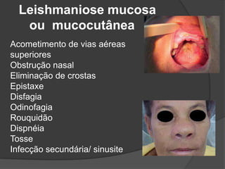 Leishmaniose mucosa
ou mucocutânea
Acometimento de vias aéreas
superiores
Obstrução nasal
Eliminação de crostas
Epistaxe
Disfagia
Odinofagia
Rouquidão
Dispnéia
Tosse
Infecção secundária/ sinusite
 