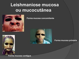 Leishmaniose mucosa
ou mucocutânea
Forma mucosa concomitante
Forma mucosa contígua
Forma mucosa primária
 