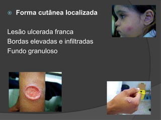  Forma cutânea localizada
Lesão ulcerada franca
Bordas elevadas e infiltradas
Fundo granuloso
 