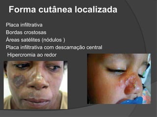 Forma cutânea localizada
Placa infiltrativa
Bordas crostosas
Áreas satélites (nódulos )
Placa infiltrativa com descamação central
Hipercromia ao redor
 