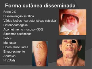 Forma cutânea disseminada
Raro: 2%
Disseminação linfática
Várias lesões –características clássica
Linfonodomegalia
Acometimento mucoso –30%
Sintomas sistêmicos:
Febre
Mal-estar
Dores musculares
Emagrecimento
Anorexia
HIV/Aids
 