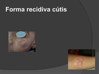 Forma recidiva cútis
 