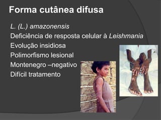 Forma cutânea difusa
L. (L.) amazonensis
Deficiência de resposta celular à Leishmania
Evolução insidiosa
Polimorfismo lesional
Montenegro –negativo
Difícil tratamento
 