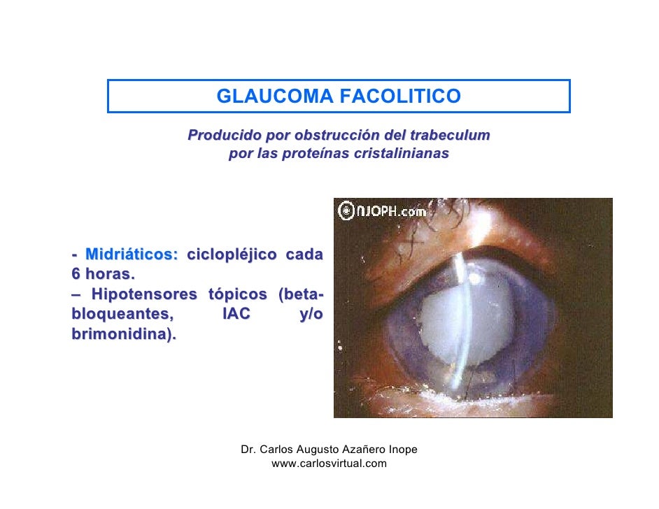 Tratamiendo Del Glaucoma Agudo Tratamiendo Del Glaucoma Agudo