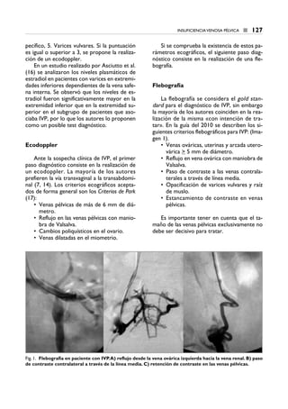 pecífico, 5. Varices vulvares. Si la puntuación
es igual o superior a 3, se propone la realiza-
ción de un ecodoppler.
En un estudio realizado por Asciutto et al.
(16) se analizaron los niveles plasmáticos de
estradiol en pacientes con varices en extremi-
dades inferiores dependientes de la vena safe-
na interna. Se observó que los niveles de es-
tradiol fueron significativamente mayor en la
extremidad inferior que en la extremidad su-
perior en el subgrupo de pacientes que aso-
ciaba IVP, por lo que los autores lo proponen
como un posible test diagnóstico.
Ecodoppler
Ante la sospecha clínica de IVP, el primer
paso diagnóstico consiste en la realización de
un ecodoppler. La mayoría de los autores
prefieren la vía transvaginal a la transabdomi-
nal (7, 14). Los criterios ecográficos acepta-
dos de forma general son los Criterios de Park
(17):
• Venas pélvicas de más de 6 mm de diá-
metro.
• Reflujo en las venas pélvicas con manio-
bra de Valsalva.
• Cambios poliquísticos en el ovario.
• Venas dilatadas en el miometrio.
Si se comprueba la existencia de estos pa-
rámetros ecográficos, el siguiente paso diag-
nóstico consiste en la realización de una fle-
bografía.
Flebografía
La flebografía se considera el gold stan-
dard para el diagnóstico de IVP, sin embargo
la mayoría de los autores coinciden en la rea-
lización de la misma «con intención de tra-
tar». En la guía del 2010 se describen los si-
guientes criterios flebográficos para IVP: (Ima-
gen 1).
• Venas ováricas, uterinas y arcada utero-
várica > 5 mm de diámetro.
• Reflujo en vena ovárica con maniobra de
Valsalva.
• Paso de contraste a las venas contrala-
terales a través de línea media.
• Opacificación de varices vulvares y raíz
de muslo.
• Estancamiento de contraste en venas
pélvicas.
Es importante tener en cuenta que el ta-
maño de las venas pélvicas exclusivamente no
debe ser decisivo para tratar.
INSUFICIENCIA VENOSA PÉLVICA ■ 127
Fig. 1. Flebografía en paciente con IVP.A) reflujo desde la vena ovárica izquierda hacia la vena renal. B) paso
de contraste contralateral a través de la línea media. C) retención de contraste en las venas pélvicas.
18 CAP VARICES_I.1.ENDOV 19/07/14 05:55 Página 127
 