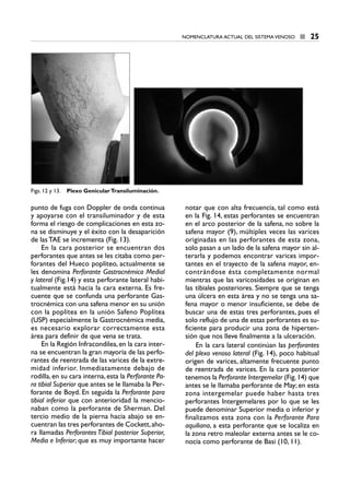 punto de fuga con Doppler de onda continua
y apoyarse con el transiluminador y de esta
forma el riesgo de complicaciones en esta zo-
na se disminuye y el éxito con la desaparición
de las TAE se incrementa (Fig. 13).
En la cara posterior se encuentran dos
perforantes que antes se les citaba como per-
forantes del Hueco poplíteo, actualmente se
les denomina Perforante Gastrocnémica Medial
y lateral (Fig.14) y esta perforante lateral habi-
tualmente está hacia la cara externa. Es fre-
cuente que se confunda una perforante Gas-
trocnémica con una safena menor en su unión
con la poplítea en la unión Safeno Poplítea
(USP) especialmente la Gastrocnémica media,
es necesario explorar correctamente esta
área para definir de que vena se trata.
En la Región Infracondilea,en la cara inter-
na se encuentran la gran mayoría de las perfo-
rantes de reentrada de las varices de la extre-
midad inferior. Inmediatamente debajo de
rodilla, en su cara interna, esta la Perforante Pa-
ra tibial Superior que antes se le llamaba la Per-
forante de Boyd. En seguida la Perforante para
tibial inferior que con anterioridad la mencio-
naban como la perforante de Sherman. Del
tercio medio de la pierna hacia abajo se en-
cuentran las tres perforantes de Cockett,aho-
ra llamadas Perforantes Tibial posterior Superior,
Media e Inferior; que es muy importante hacer
notar que con alta frecuencia, tal como está
en la Fig. 14, estas perforantes se encuentran
en el arco posterior de la safena, no sobre la
safena mayor (9), múltiples veces las varices
originadas en las perforantes de esta zona,
solo pasan a un lado de la safena mayor sin al-
terarla y podemos encontrar varices impor-
tantes en el trayecto de la safena mayor, en-
contrándose ésta completamente normal
mientras que las varicosidades se originan en
las tibiales posteriores. Siempre que se tenga
una úlcera en esta área y no se tenga una sa-
fena mayor o menor insuficiente, se debe de
buscar una de estas tres perforantes, pues el
solo reflujo de una de estas perforantes es su-
ficiente para producir una zona de hiperten-
sión que nos lleve finalmente a la ulceración.
En la cara lateral continúan las perforantes
del plexo venoso lateral (Fig. 14), poco habitual
origen de varices, altamente frecuente punto
de reentrada de varices. En la cara posterior
tenemos la Perforante Intergemelar (Fig.14) que
antes se le llamaba perforante de May; en esta
zona intergemelar puede haber hasta tres
perforantes Intergemelares por lo que se les
puede denominar Superior media o inferior y
finalizamos esta zona con la Perforante Para
aquiliana, a esta perforante que se localiza en
la zona retro maleolar externa antes se le co-
nocía como perforante de Basi (10, 11).
NOMENCLATURA ACTUAL DEL SISTEMA VENOSO ■ 25
Figs. 12 y 13. Plexo GenicularTransiluminación.
2 CAP VARICES_I.1.ENDOV 19/07/14 05:33 Página 25
 