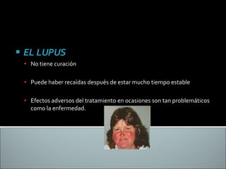 EL LUPUS No tiene curación Puede haber recaídas después de estar mucho tiempo estable Efectos adversos del tratamiento en ocasiones son tan problemáticos como la enfermedad. 