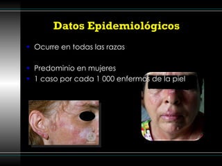 Datos Epidemiológicos  Ocurre en todas las razas Predominio en mujeres 1 caso por cada 1 000 enfermos de la piel 