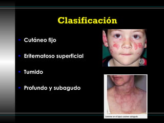 Clasificación  Cutáneo fijo Eritematoso superficial Tumido Profundo y subagudo 