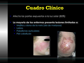 Cuadro Clínico  Afecta las partes expuestas a la luz solar (85%) La mayoría de los enfermos presenta lesiones limitadas a: Mejillas y dorso de la nariz (ala de mariposa) Labios Pabellones auriculares Piel cabelluda 