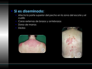 Si es diseminado: Afecta la parte superior del pecho en la zona del escote y el cuello Caras externas de brazos y antebrazos Dorso de manos Dedos 