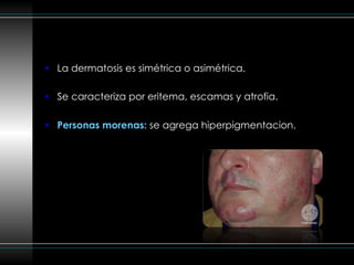 La dermatosis es simétrica o asimétrica. Se caracteriza por eritema, escamas y atrofia. Personas morenas:  se agrega hiperpigmentacion. 