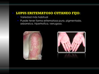 LUPUS ERITEMATOSO CUTANEO FIJO : Variedad más habitual Puede tener forma eritematosa pura, pigmentada, seborreica, hipertrofica, verrugosa. 