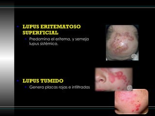 LUPUS ERITEMATOSO SUPERFICIAL Predomina el eritema, y semeja lupus sistémico. LUPUS TUMIDO Genera placas rojas e infiltradas 