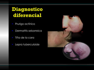 Diagnostico  diferencial  Prurigo actínico Dermatitis seborreica Tiña de la cara  Lepra tuberculoide 