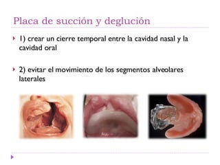 Placa de succión y deglución <ul><li>1) crear un cierre temporal entre la cavidad nasal y la cavidad oral </li></ul><ul><l...