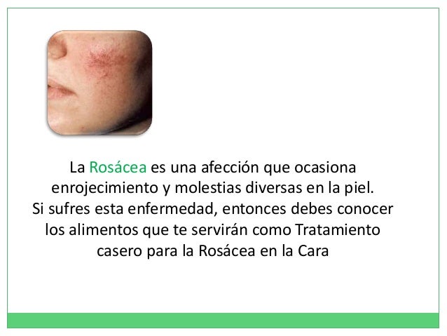 Tratamiento Casero Para La Rosacea En La Cara