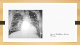 • Lineas B de Kerly (flechas
blancas)
 