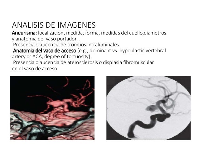 Tratamiento De Aneurismas Cerebrales Rotos