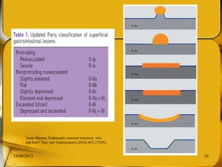 14/08/2013 35
Jayan Mannat, Endoscopic mucosal resection: who
and how? Ther Adv Gastroenterol (2010) 4(5) 275282
 