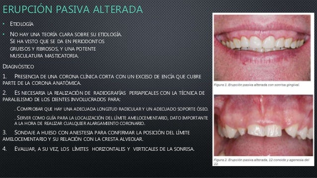 Tratamiento De Las Alteraciones Del Margen Gingival Mediante Cirugia