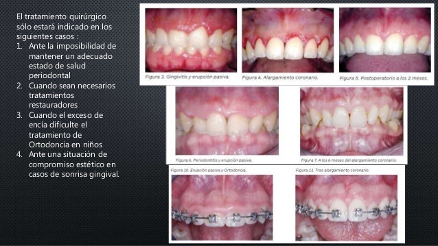 Tratamiento De Las Alteraciones Del Margen Gingival Mediante Cirugia