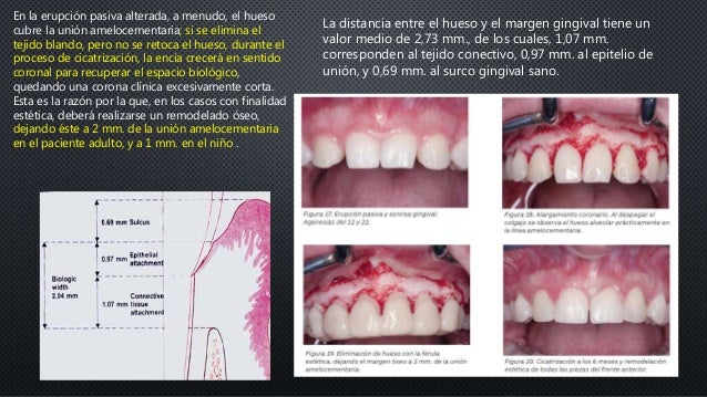 Tratamiento De Las Alteraciones Del Margen Gingival Mediante Cirugia
