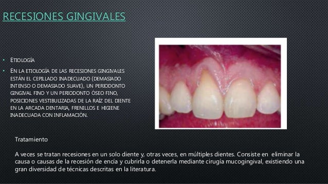 Tratamiento De Las Alteraciones Del Margen Gingival Mediante Cirugia