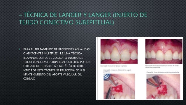 Tratamiento De Las Alteraciones Del Margen Gingival Mediante Cirugia