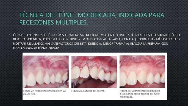 Tratamiento De Las Alteraciones Del Margen Gingival Mediante Cirugia