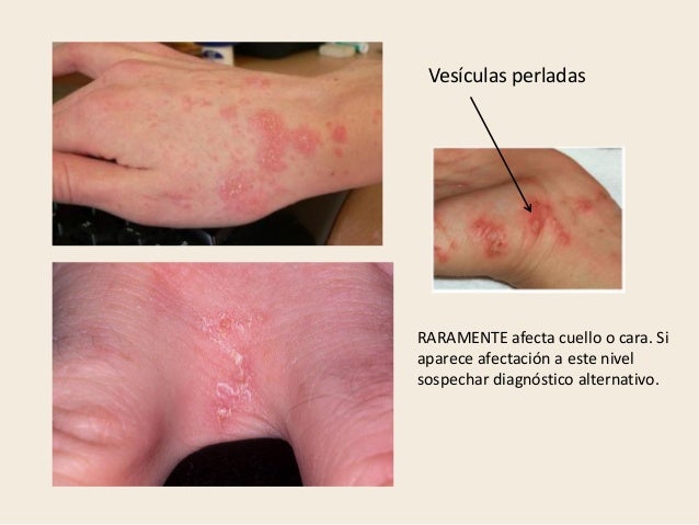 La psoriasis en la nariz como curar