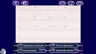 Taquicardia ventricular
FA preexcitada
TSV con aberrancia
Taquicardia sinusal
 