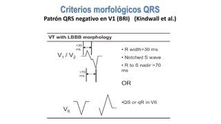 Criterios morfológicos QRS
Patrón QRS negativo en V1 (BRI) (Kindwall et al.)
 
