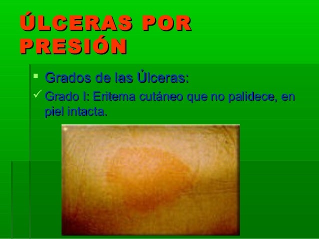 Como hackear Regaliz hipertensión
