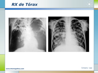 RX de Tórax
Company Logo
www.themegallery.com
 