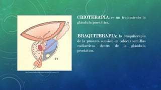 CRIOTERAPIA: es un tratamiento la
glándula prostática.

BRAQUITERAPIA: la braquiterapia
de la próstata consiste en colocar semillas
radiactivas dentro de la glándula
prostática.

http://www.unidadurologia.es/portaluu/portal?content=1:57

 