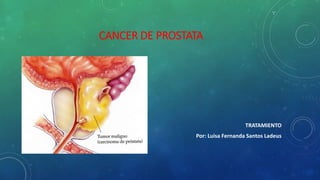 CANCER DE PROSTATA

TRATAMIENTO
Por: Luisa Fernanda Santos Ladeus

 