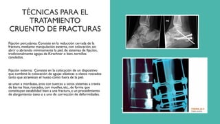 TÉCNICAS PARA EL
TRATAMIENTO
CRUENTO DE FRACTURAS
Fijación percutánea: Consiste en la reducción cerrada de la
fractura, mediante manipulación externa, con colocación, sin
abrir o abriendo mínimamente la piel, de sistemas de fijación,
tradicionalmente agujas de Kirschner o bien, tornillos
canulados.
Fijación externa: Consiste en la colocación de un dispositivo
que combine la colocación de agujas elásticas o clavos roscados
tanto que atraviesan el hueso como fuera de la piel.
se unan a mordazas, aros con tuercas u otros sistemas a través
de barras lisas, roscadas, con muelles, etc., de forma que
constituyan estabilidad bien a una fractura, a un procedimiento
de alargamiento óseo o a uno de corrección de deformidades.
 