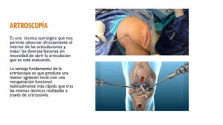 ARTROSCOPÍA
Es una técnica quirúrgica que nos
permite observar directamente el
interior de las articulaciones y
tratar las diversas lesiones sin
necesidad de abrir la articulación
que se está evaluando.
La ventaja fundamental de la
artroscopia es que produce una
menor agresión local, con una
recuperación funcional
habitualmente más rápida que tras
las mismas técnicas realizadas a
través de artrotomía.
 