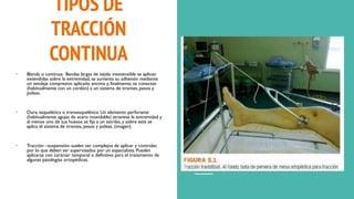 TIPOS DE
TRACCIÓN
CONTINUA
• Blanda o continua: Bandas largas de tejido inextensible se aplican
extendidas sobre la extremidad, se aumenta su adhesión mediante
un vendaje compresivo aplicado encima y, finalmente, se conectan
(habitualmente con un cordón) a un sistema de tirantes, pesos y
poleas.
• Dura, esquelética o transesquelética: Un elemento perforante
(habitualmente agujas de acero inoxidable) atraviesa la extremidad y
al menos uno de sus huesos se fija a un estribo, y sobre este se
aplica el sistema de tirantes, pesos y poleas. (imagen)
• Tracción –suspensión: suelen ser complejos de aplicar y controlar,
por lo que deben ser supervisados por un especialista. Pueden
aplicarse con carácter temporal o definitivo para el tratamiento de
algunas patologías ortopédicas.
 